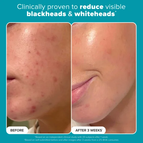 Paula's Choice Skin Perfecting 2% BHA Liquid Exfoliant (118ml) Image 3